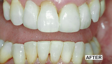 cosmetic-dentistry_case1_after_small