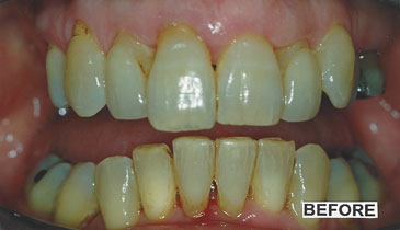 cosmetic-dentistry_case1_before_small
