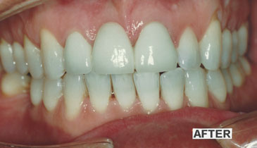 bleaching_case1_after_small