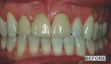 bleaching_case1_before_small