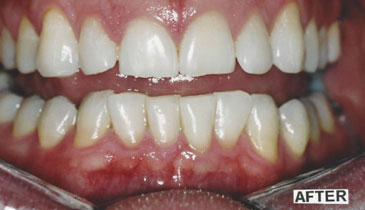 bleaching_case2_after_small