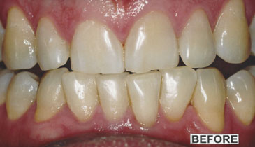 bleaching_case2_before_small
